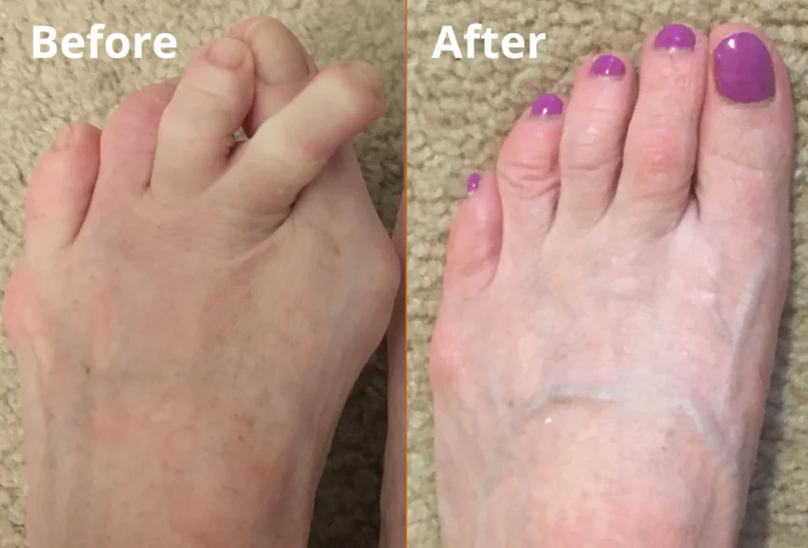 Hyggear Toe Separators